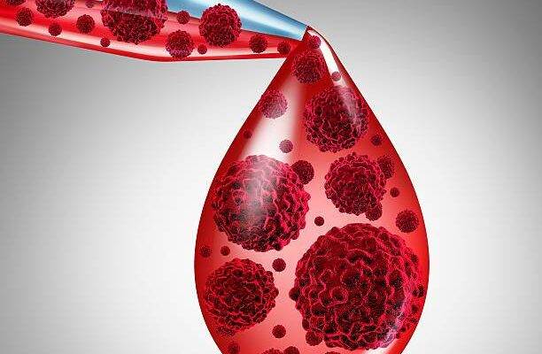 Akut lenfoblastik lösemi