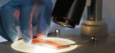 Kronik lenfositer lösemi tanısı