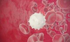 Akut miyeloid lösemi nedir