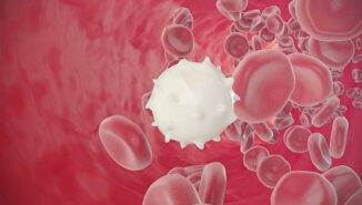 Akut miyeloid lösemi