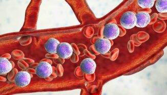 Akut promyelositik lösemi nedir?