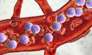 Akut promyelositik lösemi nedir?