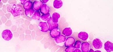 Lösemi hastaları nelere dikkat etmelidir