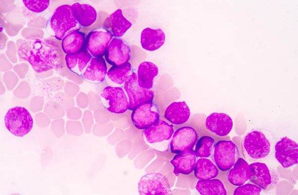 Lösemi hastaları nelere dikkat etmelidir?