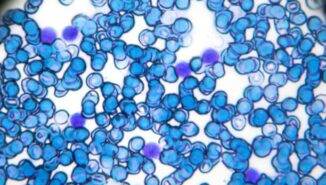 Lenfosit düşüklüğü ve Lenfosit yüksekliği