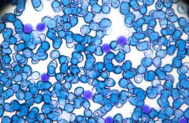 Lenfosit düşüklüğü ve Lenfosit yüksekliği